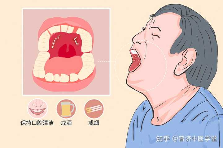 什么是口腔癌,如何早期发现和治疗? - 知乎