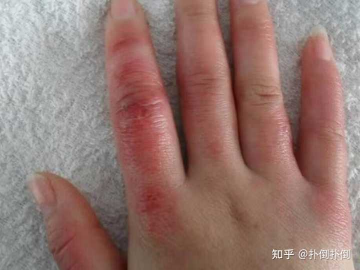 冻疮长什么样? - 知乎