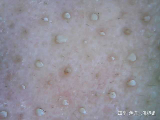 黑头和白头有什么区别? - 知乎
