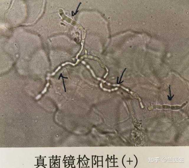有哪种方法可以彻底根治股癣? - 知乎