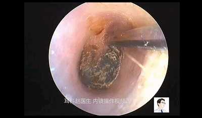 经常用棉签掏耳朵真的会堵塞耳道吗