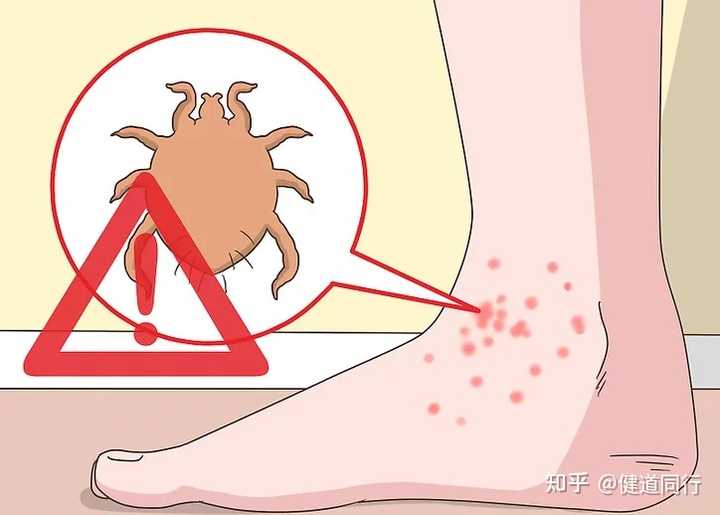 最近脚特别痒,用什么药可以根治? - 知乎