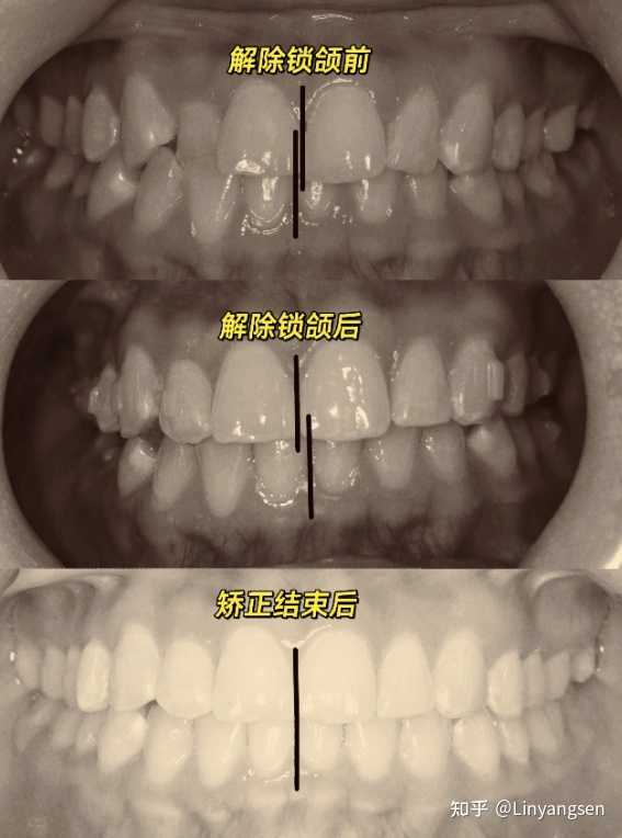 如何确定是否偏颌,以及偏颌的性质? - 知乎