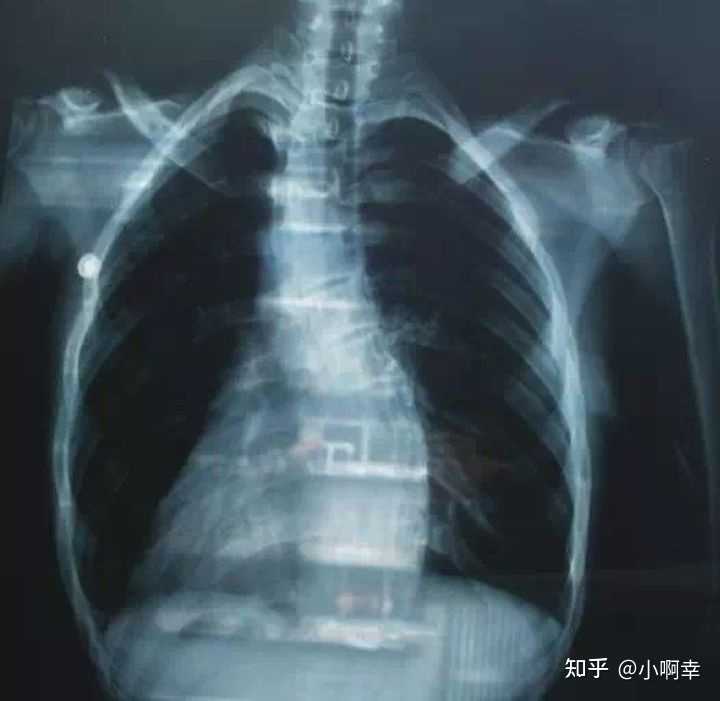 关于胸椎侧弯该怎么矫正? - 知乎
