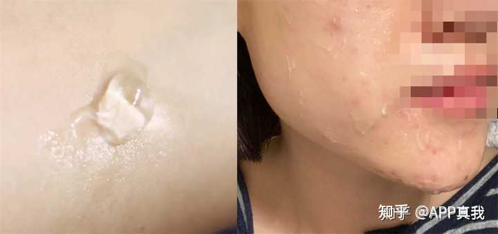 痘印心得经验_痘印心得经验_痘印心得经验