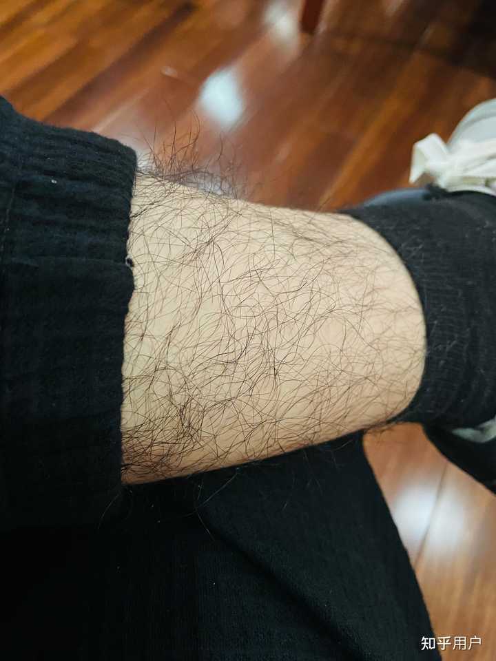 22岁男性雄激素过多，体毛多手毛长腿毛多腹部有，胸毛也开始冒，乳晕长了一圈，雄激素降下来体毛会消退吗？ - 知乎