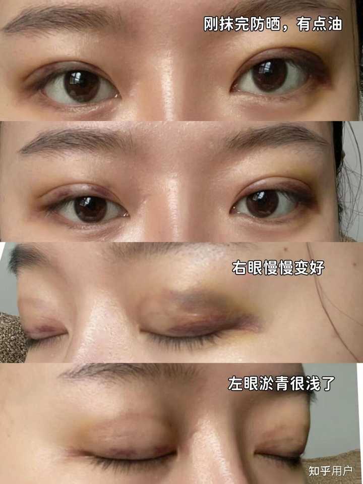 双眼皮法埋线价格多少_双眼皮埋线价格_埋线法双眼皮价格