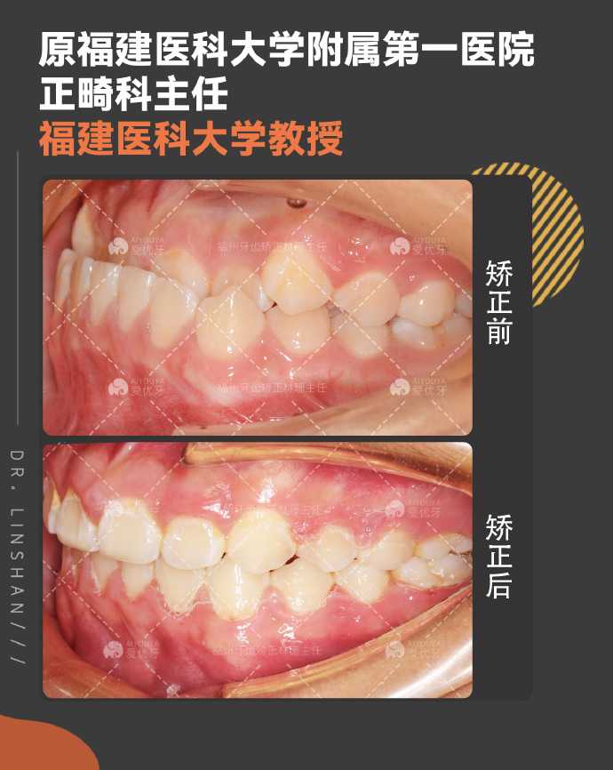你的反颌(地包天)正畸矫正成功了吗? - 知乎