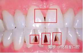 门牙有缝怎么补? - 知乎