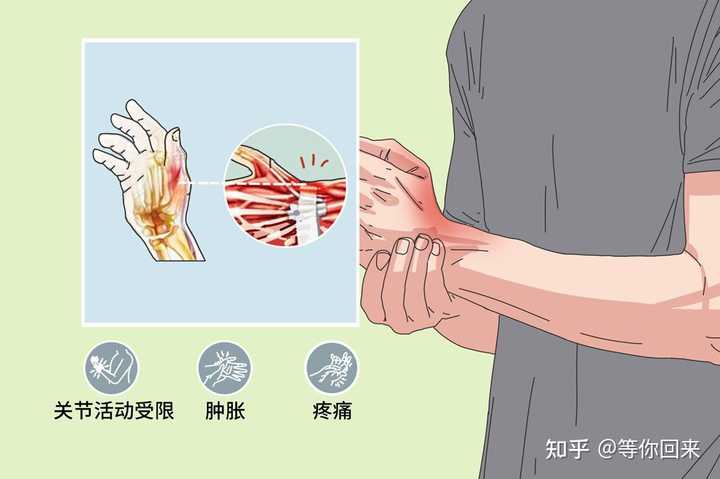 如何有效预防手腕腱鞘炎 知乎