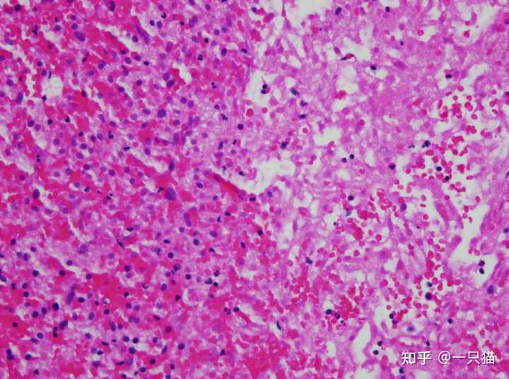 如何简述坏死的常见类型、病理特点及结局? - 知乎