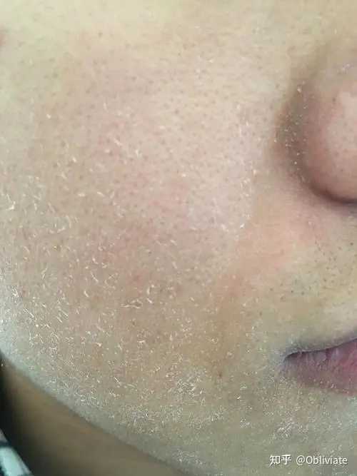 脸部皮肤干燥皮屑该如何处理? - 知乎