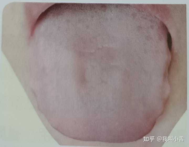 舌头上有裂纹是什么原因引起的? - 知乎
