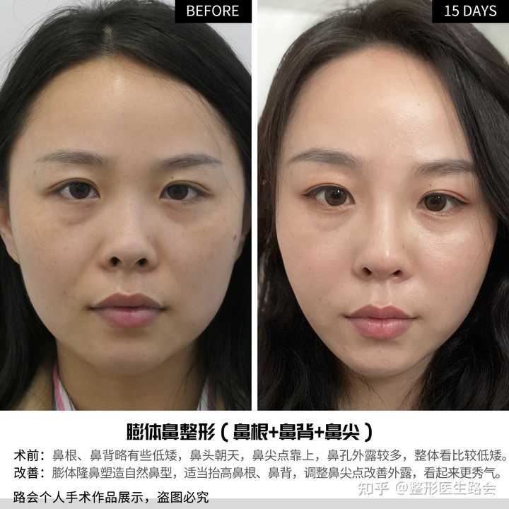 什么是朝天鼻?可纠正吗? - 知乎