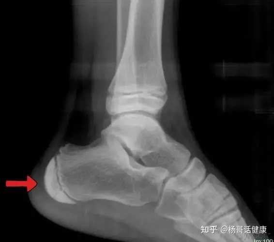 引发脚后跟长骨刺的原因是什么? - 知乎