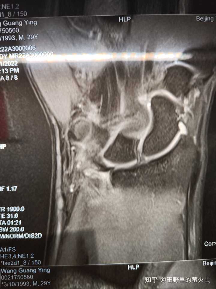 大家得了tfcc都是怎么好的? - 知乎