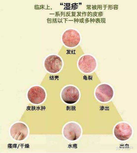 湿疹皮炎会传染吗？一般会出现在什么部位？ - 知乎