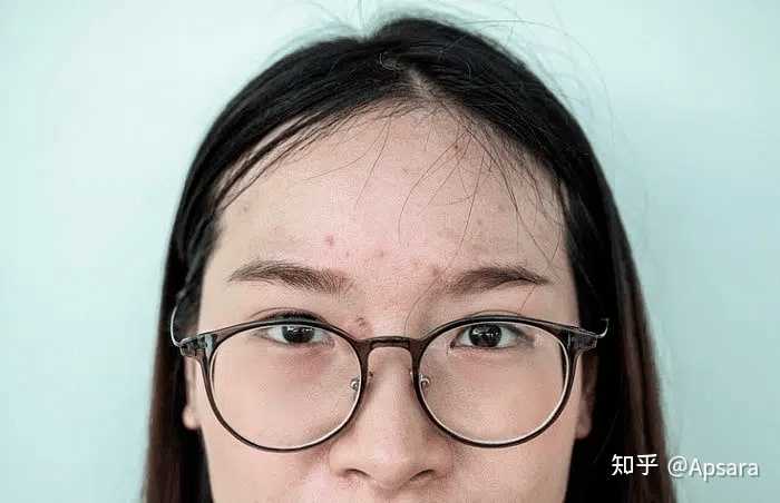 脸上长痘的原因跟过敏有关吗？ - 知乎