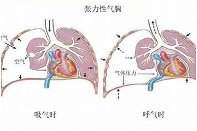 血气胸的临床特征有哪些? - 知乎