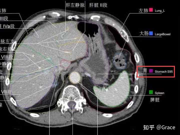 本人想做除胃镜以外的胃部的影像学检查，腹部CT检查包括胃部吗？还是归胸部CT检查呢？ - 知乎