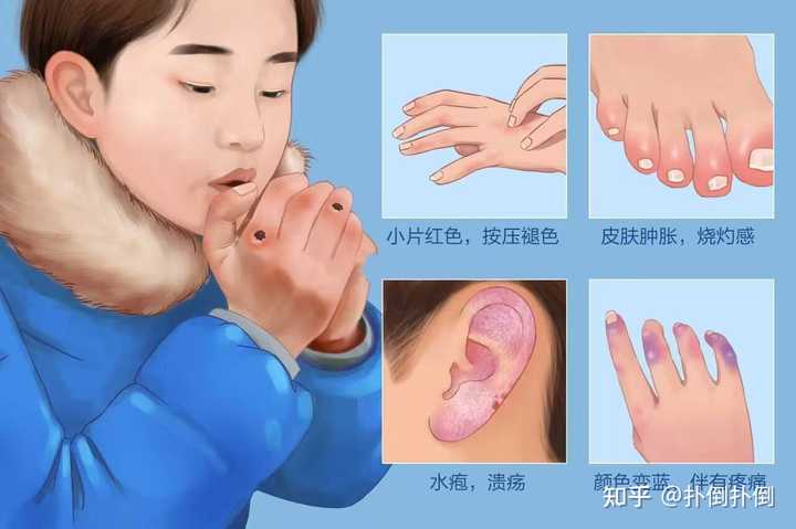 冻疮长什么样? - 知乎