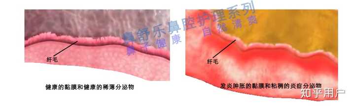 筛窦炎怎么治疗？ - 知乎