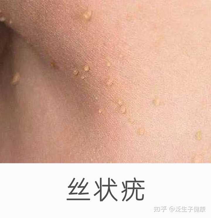 感染hpv后，身体会出现哪些症状？