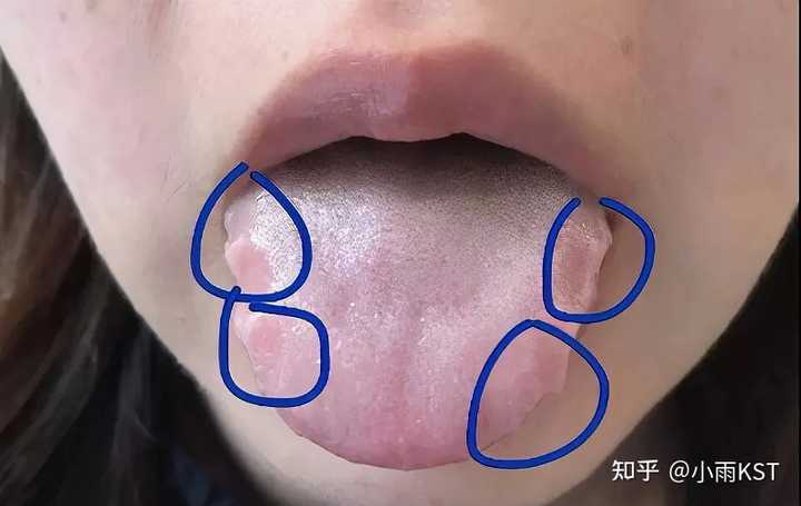 舌头两边有齿痕的原因有哪些? - 知乎