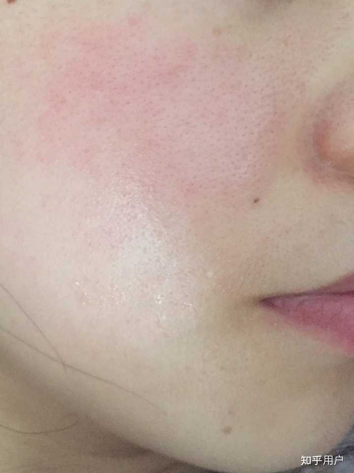 快速改善皮肤泛红敏感真的很难吗? - 知乎