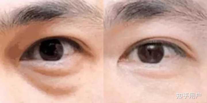 面部皱纹都有哪些种类?形成原因?如何除皱? - 知乎