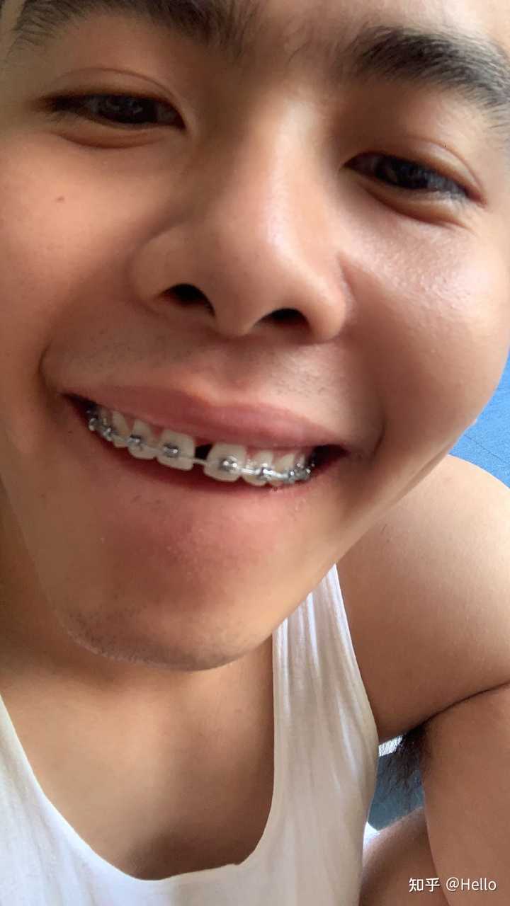 你们戴牙套都戴了多长时间？