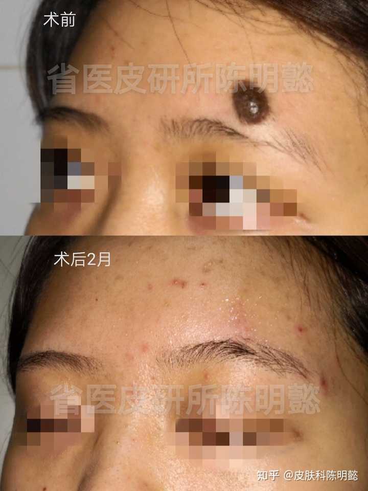 脸上的痦子能随便点吗？ - 知乎