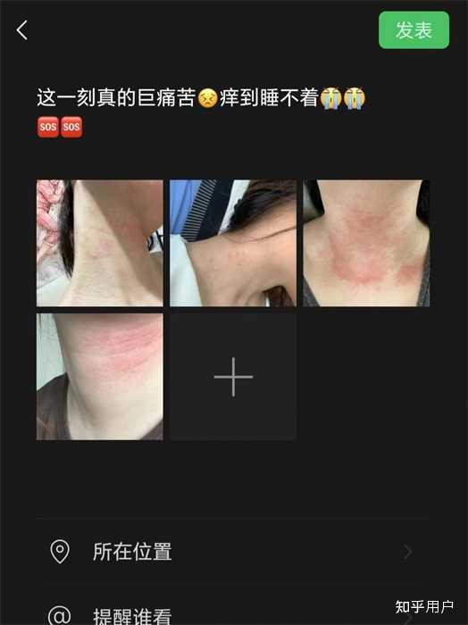身上痒,一挠起疙瘩,越挠越多,忍住不挠会逐渐消失。? - 知乎
