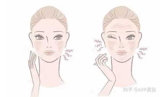 痘印心得经验_痘印心得经验_痘印心得经验
