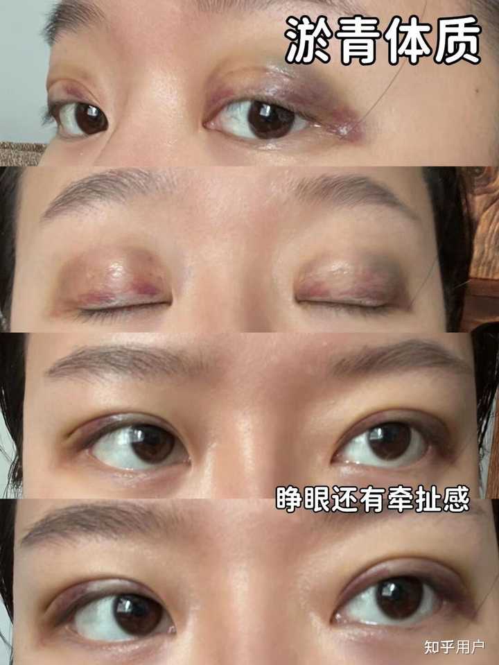 双眼皮埋线价格_双眼皮法埋线价格多少_埋线法双眼皮价格