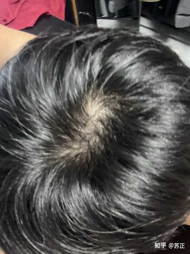 发旋处能看到头皮，是脱发吗？ - 知乎