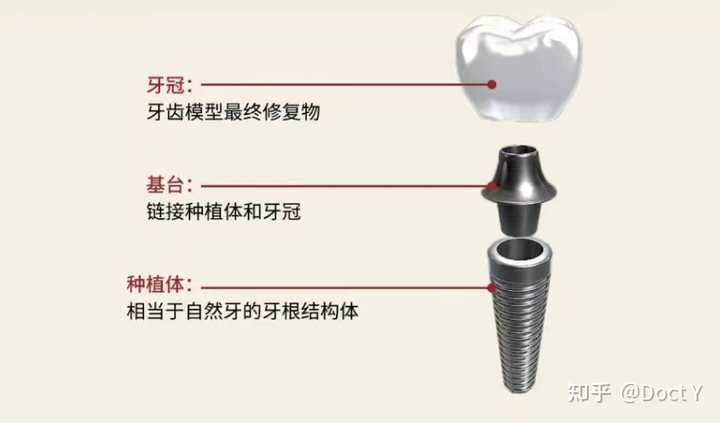 种植牙愈合基台的作用是什么? - 知乎