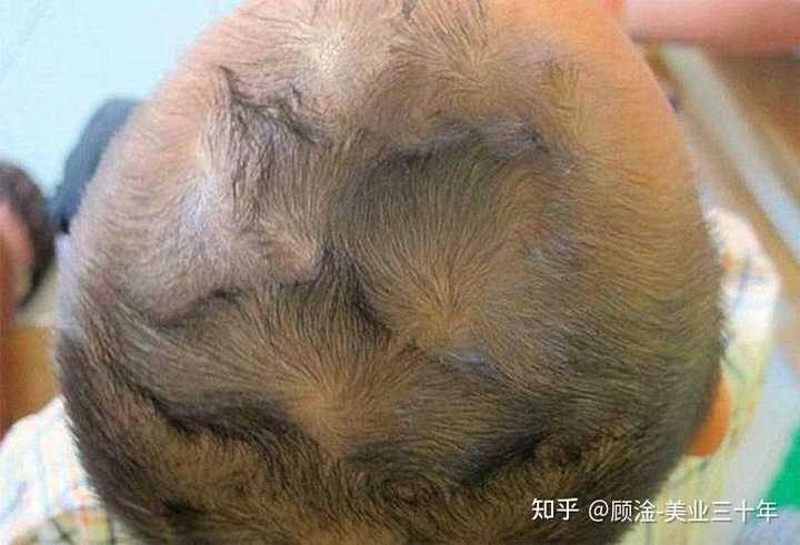 我的这个发旋处的发量是正常的吗？ - 知乎