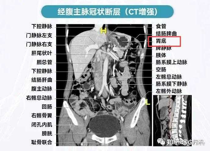 本人想做除胃镜以外的胃部的影像学检查,腹部CT检查包括胃部吗?还是归胸部CT检查呢? - 知乎