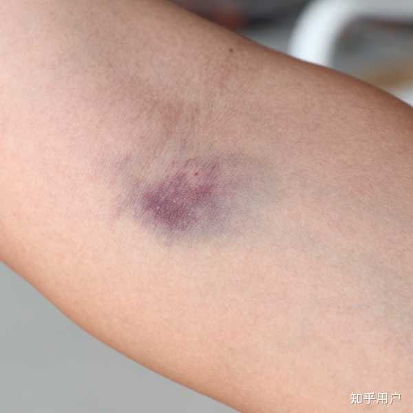 抽血后没有按住针孔，皮肤淤青、充血怎么办？ - 知乎