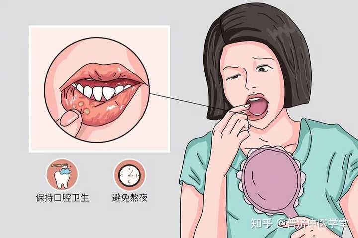 什么是口腔癌,如何早期发现和治疗? - 知乎