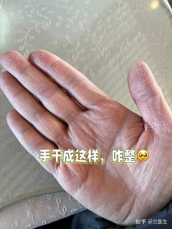 手上总是皲裂,是缺什么? - 知乎