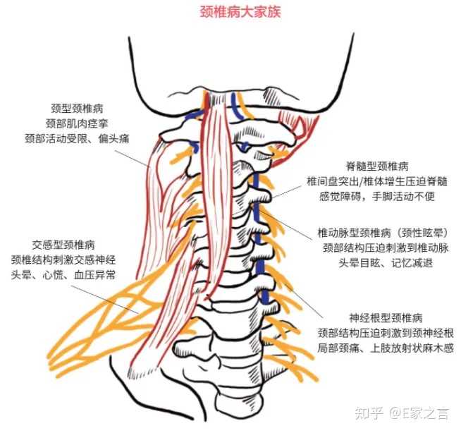硬膜囊与神经根有何区别? - 知乎