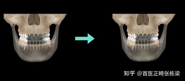 偏颌是怎样一种体验? - 知乎