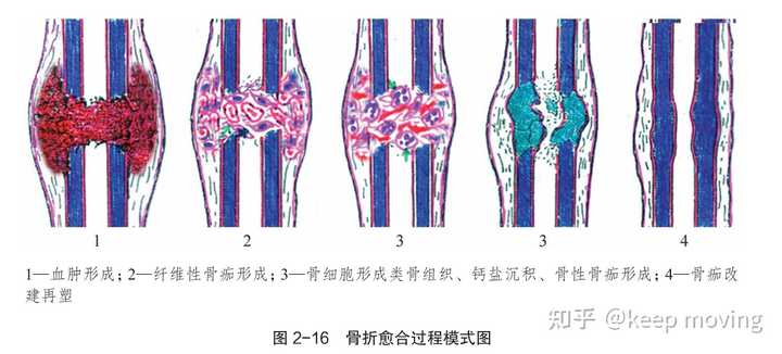 骨折后骨头到底是怎样愈合的? - 知乎