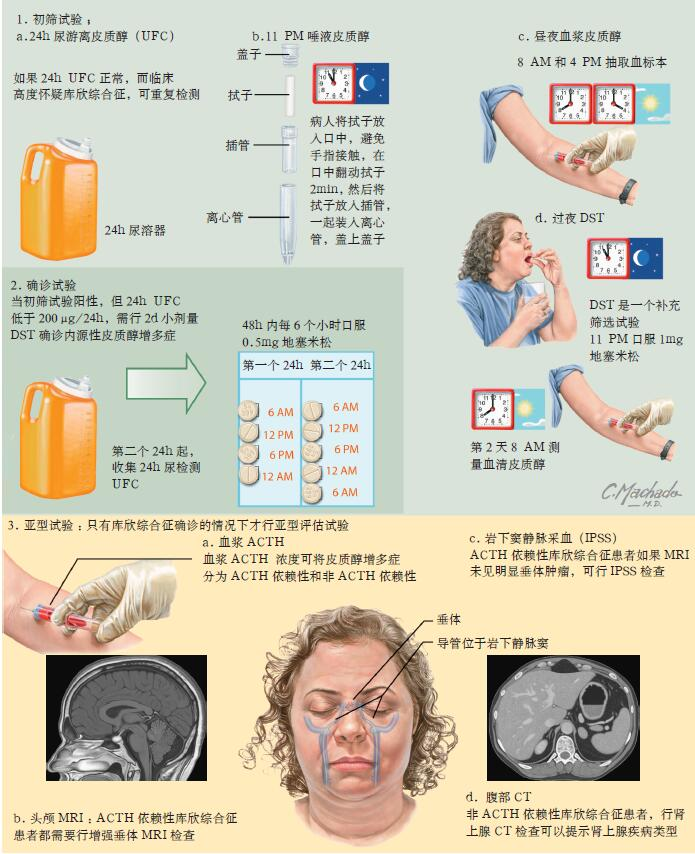 国内治疗库欣综合征有哪些方案? - 知乎
