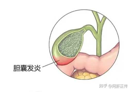 胆囊炎患者有哪些常见的症状表现? - 知乎