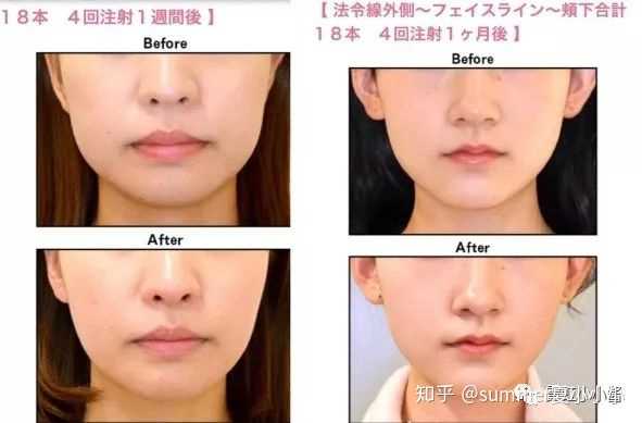 可以请学医或者医美的人谈谈溶脂针的效果或危害吗 打过的人献身说法最好了 Summer夏小小小的回答 可以请学医或者医美的人谈谈溶脂针的效果或危害吗 打过的人献身说法最好了 Summer夏小小小的回答