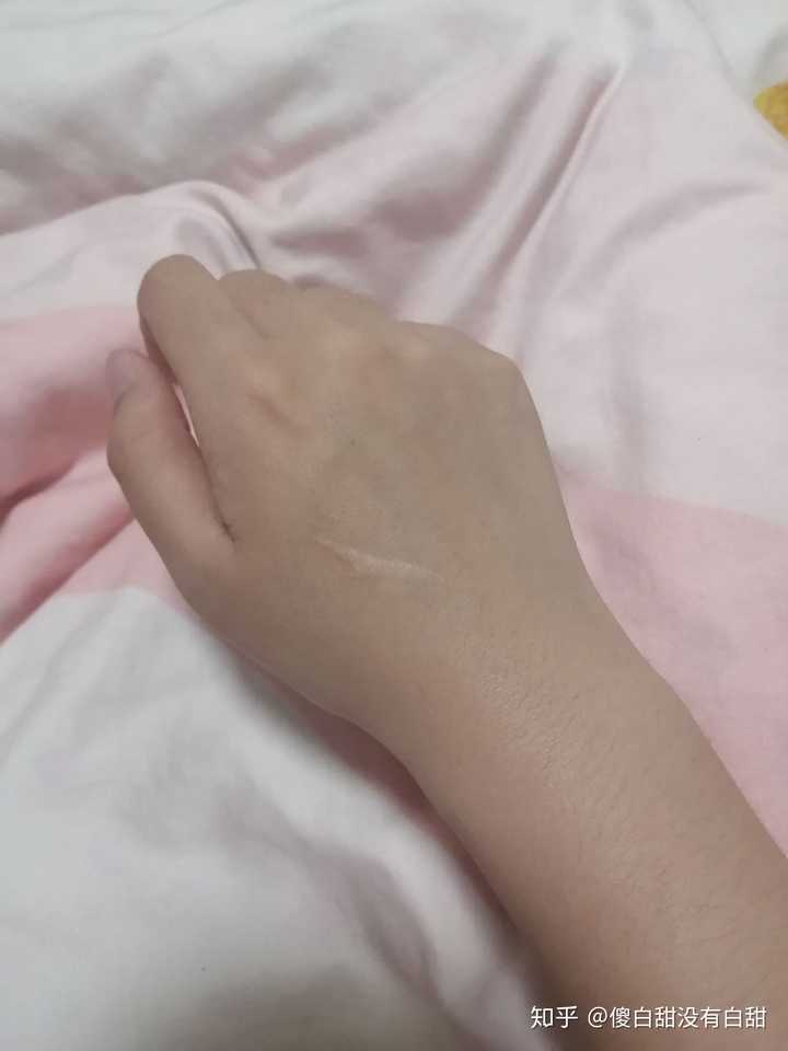 怎样去掉手上的疤？ - 知乎