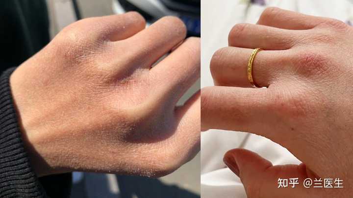 冬天手部干燥脱皮,究竟如何才能彻底改善? - 知乎